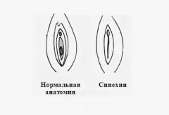 Синехии половых губ - причины, симптомы, лечение и профилактика